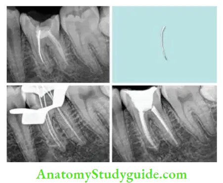 Endodontic Failures And Retreatment Management of mandibular first molar with separated instrument