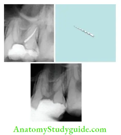Endodontic Failures And Retreatment Management of maxillary first molar with separated instrument