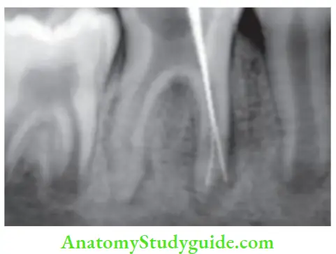 Endodontic Failures And Retreatment Perforation in mesiobuccal canal of mandibular fist molar decreases the prognosis of treatment.