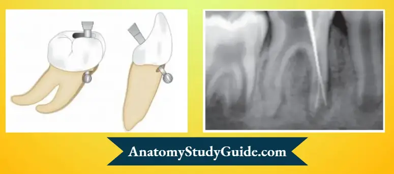 Endodontic-Failures-And-Retreatment-Perforation-of-molar-anterior-tooth-due-to-misdirection-of-bur