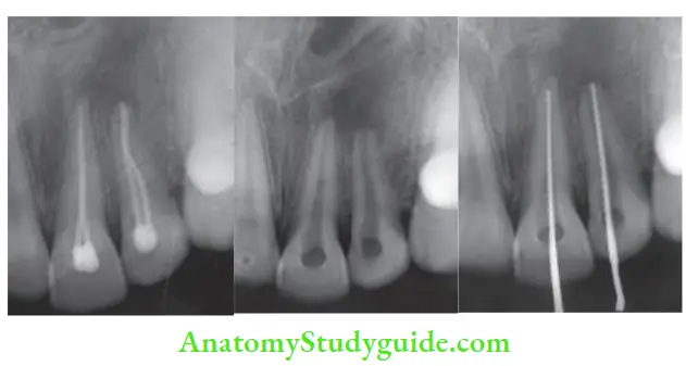 Endodontic Failures And Retreatment Preoperative radiograph showing defective root canal of 21; Radiograph after gutta-percha removal; Working length radiograph