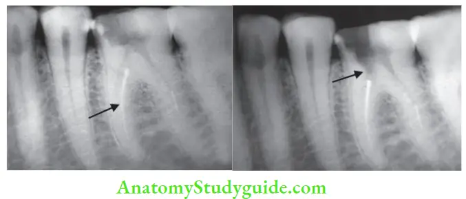 Endodontic Failures And Retreatment Preoperative radiograph showing separated instrument in mesiobuccal canal of mandibular fist molar; Groove made for ultrasonic tip to reach the fie head