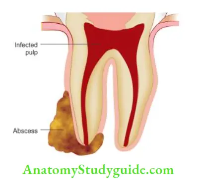 Endodontic Failures And Retreatment Presence of infected tissue may affct the repair of periapical tissues resulting in endodontic failure.