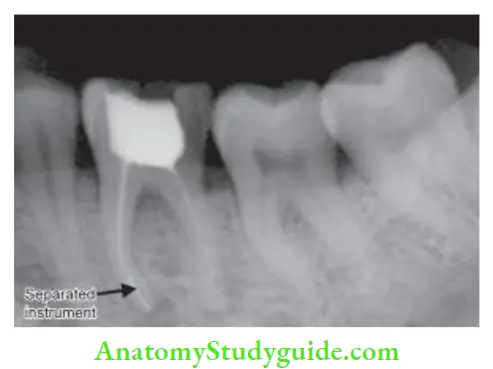 Endodontic Failures And Retreatment Radiograph showing periapical lesion associated with mesiobuccal canal with separated instrument in mandibular first molar.