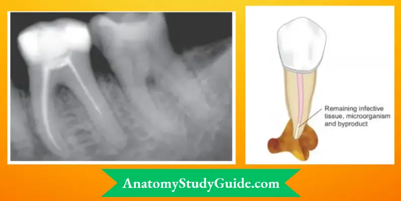 Endodontic-Failures-And-Retreatment-Radiograph-showing-periapical-radiolucency-due-to-underobturated-distal-canal-of-mandibular-second-molar