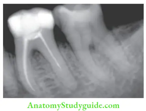 Endodontic Failures And Retreatment Radiograph showing periapical radiolucency due to underobturated distal canal of mandibular second molar.