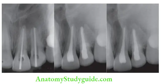 Endodontic Failures And Retreatment Radiograph with master cone in place; Radiograph after obturation; Follow-up after 6 months showing periapical healing.