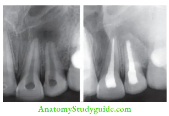 Endodontic Failures And Retreatment Radiographic evaluation of periapical radiolucency in relation to maxillary central incisors