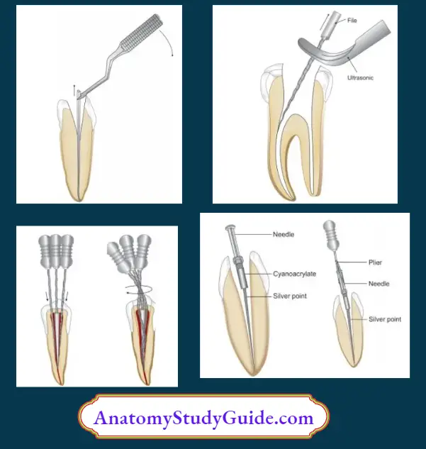 Endodontic Failures And Retreatment Removal of silver point using microsurgical forcep.