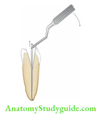 Endodontic Failures And Retreatment Removal of silver point using microsurgical forcep.