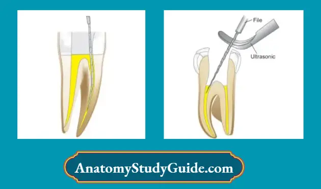 Endodontic-Failures-And-Retreatment-Removal-of-soft-setting-paste-using-normal-endodontic-instrument-in-crown-down-technique