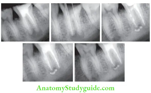 Endodontic Failures And Retreatment Retreatment of mandibular left second molar with periradicular radiolucency treated with D-fies, metapex and MTA