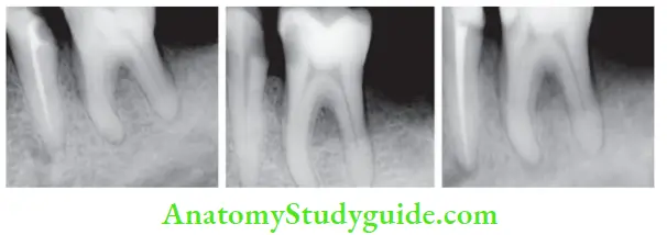 Endodontic Failures And Retreatment Retreatment of mandibular left second premolar using protaper universal retreatment fies and one shape single file System