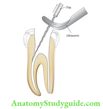 Endodontic Failures And Retreatment Notes - Anatomy Study Guide