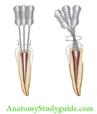 Endodontic Failures And Retreatment Use of hedstroem fies to remove silver point, fies are twisted around each other by making clockwise rotation to grip the silver point.