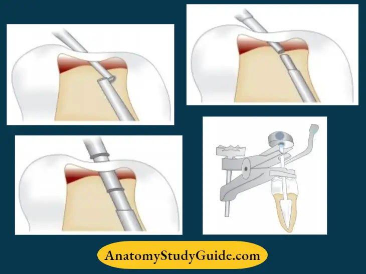 Endodontic-Failures-And-Retreatment-Use-of-transmetal-bur-for-dooming-head-of-posthead