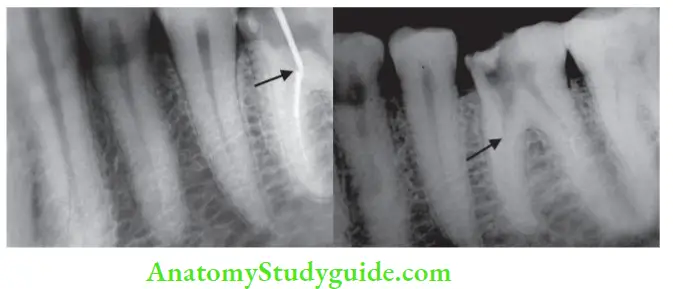 Endodontic Failures And Retreatment Usltrasonic tip checked for its path till it reaches file; Postoperative radiograph showing after fie retrival.