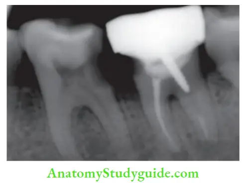 Endodontic Failures And Retreatment poor marginal adaptation and secondary caries under coronal restoration. It is advisable to remove such restoration before retreatment.