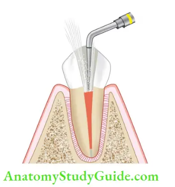 Endodontic Instruments Continuous irrigation using endosonics produce cleaner canals.