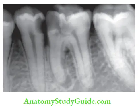 Endodontic Microbiology Notes deep carious lesion in mandibular 2nd premolar and 1st molar involving the pulp.