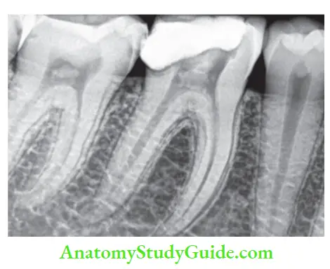 Endodontic Microbiology Notes faulty restoration in mandibular 1st molar involving pulp.