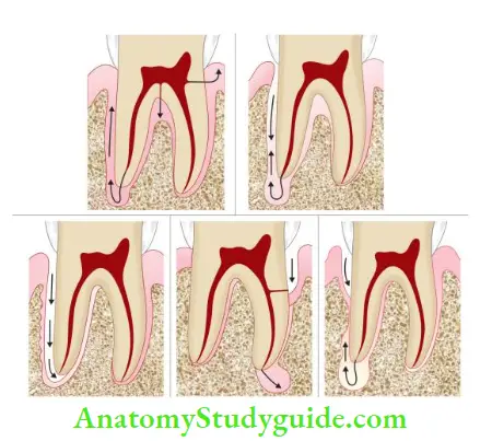 Endodontic Periodontal Lesions Classifiation of Endodontic–Periodontal Lesions