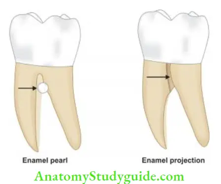 Endodontic Periodontal Lesions Enamel pearl and projections.