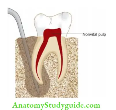 Endodontic Periodontal Lesions In true combined endodontic-periodontal lesion at the base of periodontal lesion the probe abruptly drops farther down the root and extend to tooth apex.