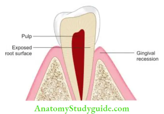Endodontic Periodontal Lesions Loss of cementum can occur because of gingival recession.