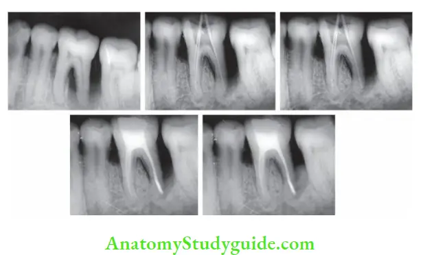 Endodontic Periodontal Lesions Management of endodontic-periodontic lesion in mandibular left fist molar