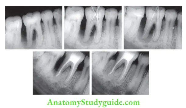 Endodontic Periodontal Lesions Management of endodontic-periodontic lesion in mandibular right fist molar