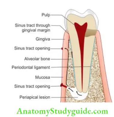 Endodontic Periodontal Lesions Pathway for exchange of noxious agents between endodontic and periodontal tissue.