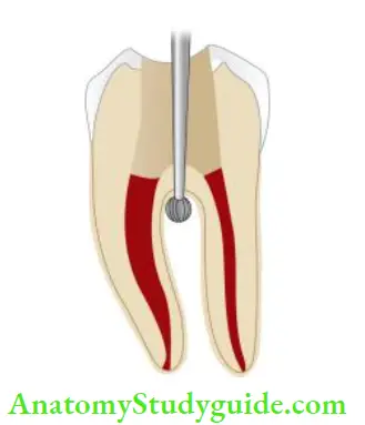 Endodontic Periodontal Lesions Perforation of root creates communication between root canal system and periodontium.