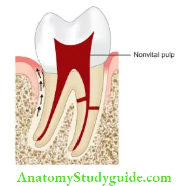 Endodontic Periodontal Lesions Primary endodontic lesion with secondary periodontal involvement.