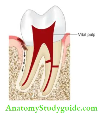 Endodontic Periodontal Lesions Primary periodontal lesion.