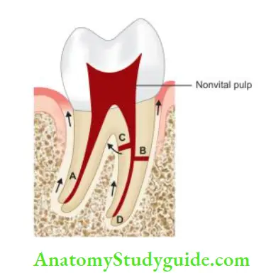 Endodontic Periodontal Lesions Spread of infection can occur