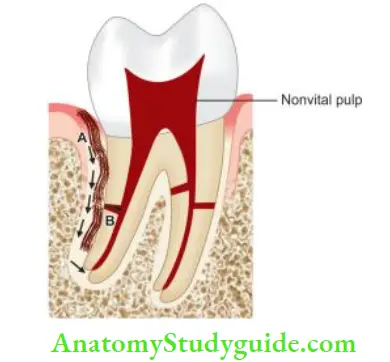 Endodontic Periodontal Lesions Primary periodontal lesion.