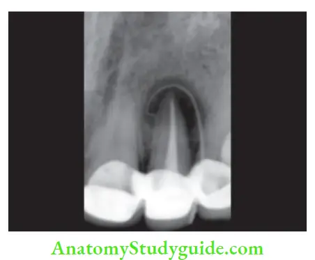Endodontic Periodontal Lesions Tracking a sinus tract using gutta-percha and then taking radiograph.
