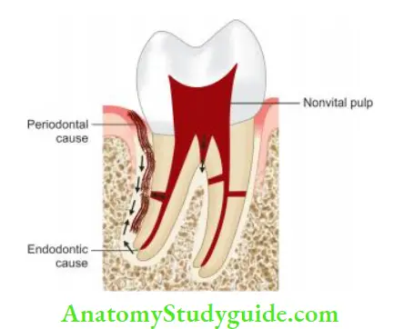 Endodontic Periodontal Lesions True combined endo–perio lesion