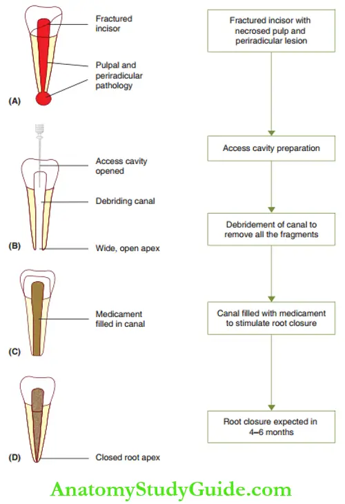 Endodontic Treatment Of Young Permanent Teeth Apexification Procedure On A Fractured Incisor With A Necrotic Pulp And A Periradicular Lesion