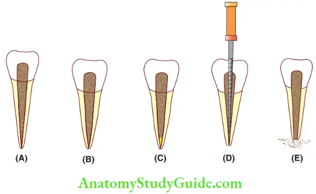 Endodontic Treatment Of Young Permanent Teeth Outcomes Of The Apexification Procedure