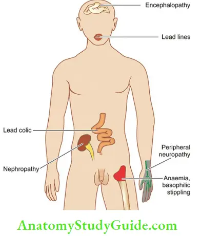 Environmental Diseases Complications Of Lead Poisoning