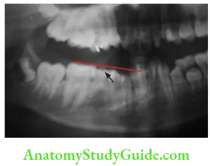 Eruption And Exfoliation Of Teeth Radiograph Of A Submerged Molar The Red Line Indicates The Occlusal Plane