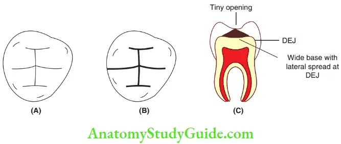 Essentials Of Dental Caries (A)Uninvolved Pits And Fissures, (B)Coronal View Of Pit And Fissure Caries And (C)Sagittal View Of Pit And Fissure Caries