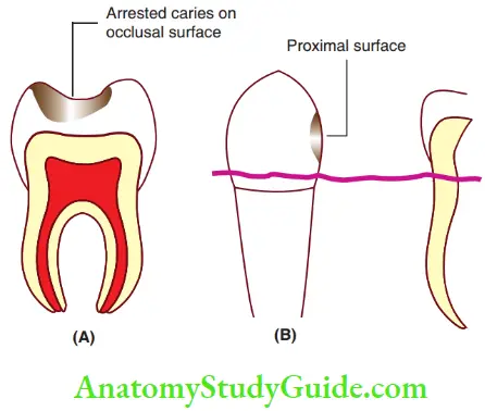 Essentials Of Dental Caries Arrested Caries Is Characterised By A Wider, Self Cleansable Cavity That Demonstrates Poor Food Retention