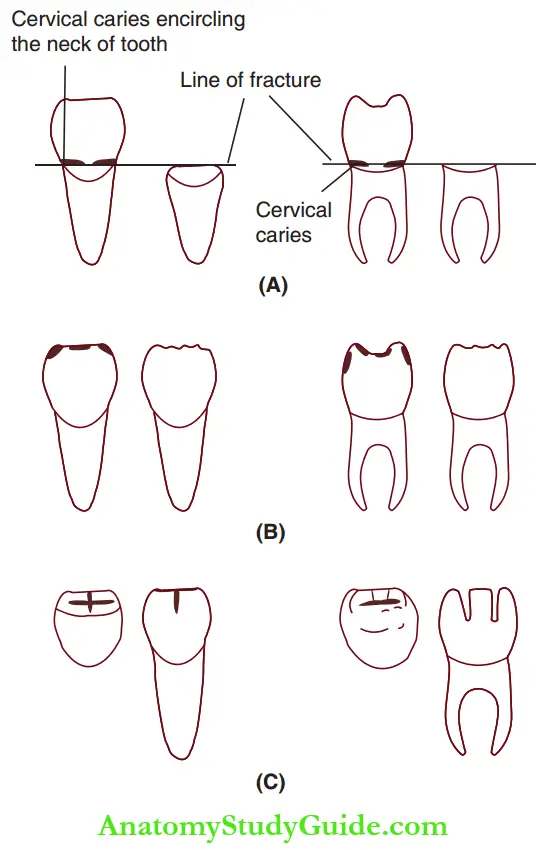 Essentials Of Dental Caries Manifestations Of Radiation Caries