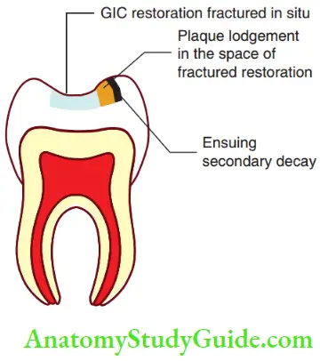 Essentials Of Dental Caries Recurrent Caries Associated With Fluoride Releasing Restoration No Decay Forms Owing To Fluoride Release From Retoration GIC Glass Ionomer Cement