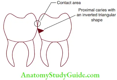 Essentials Of Dental Caries Smooth Surface Caries Assumes A Shape Of An Inverted Triangle With A Wider Opening