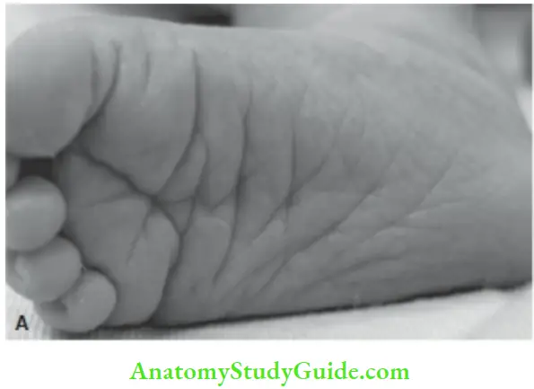 Examination Of A Newborn Baby A Deep Sole Crease Covering Two Thirds Of Sole Are Indicative Of Term Gestational Maturity While