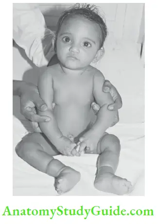 Examination Of A Newborn Baby Amputation Of Digits And Deep Groovs Over The Legs Due To Amniotic Bands